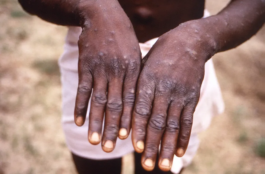 LA County sees rise in mpox cases; health officials urge vaccinations